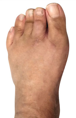 Osteotomy Bunionectomy After Picture, University Foot and Ankle Institute Los Angeles