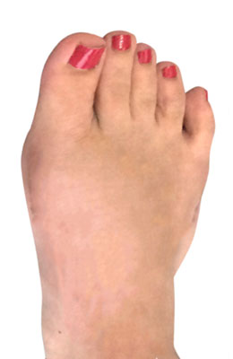 Lapidus Bunion Surgery after Image