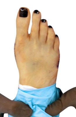 Osteotomy Bunionectomy and Tailors Bunionectomy After Picture