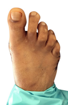 Osteotomy Bunionectomy and Osteotomy Tailors Bunionectomy After Surgery Picture