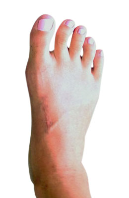 Lapidus Bunion Pciture Six Weeks After  Surgery, UFAI