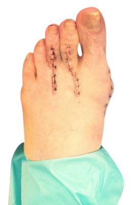 After picture: Osteotomy Bunionectomy, Hammertoe Correction Plantar Plate Repair
