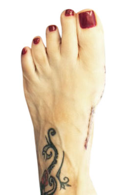 After picture: Lapidus Bunionectomy