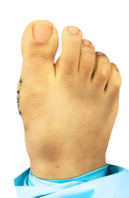 Lapidus Bunionectomy Immediately After Surgery Picture, UFAI