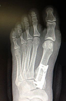 Lapidus Bunionectomy Surgery After Picture