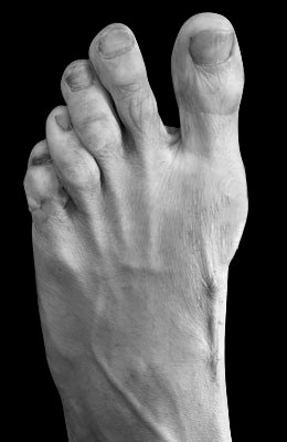 Lapidus Bunionectomy, Hammertoe 5th Intermediate After Surgery, Univeristy Foot and Ankle Institute