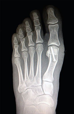 Head Osteotomy After Surgery - University Foot and Ankle Institute