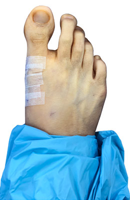 Osteotomy Bunionectomy, Before and After Picture, University Foot and Ankle Institute