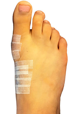 Pediatric bunion surgery, lapidus bunionectomy, before and after picture, university foot and ankle institute