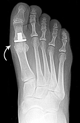 Hallux Limitus Bunion Surgery post, University Foot and Anke Insittute