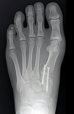 Lapidus After Surgery - University Foot and Ankle Institute