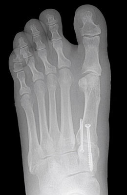 Lapidus After Surgery - University Foot and Ankle Institute