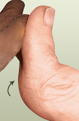Hallux Limitus After Surgery - University Foot and Ankle Institute