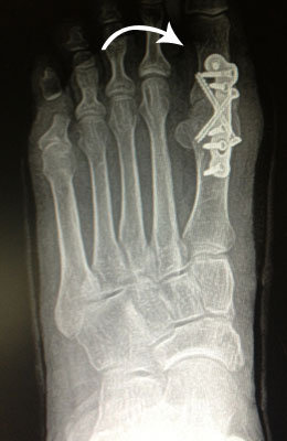 Big toe arthritis surgery after picture