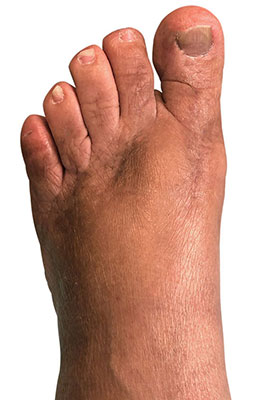 Hallux Rigidus MPJ Fusion before and after picturesFirst MPJ fusion, University Foot and Ankle Institute