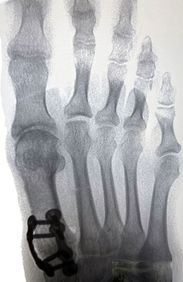 Lapiplasty after image