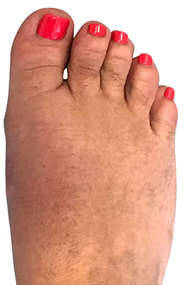 Minvasive minimally invasive bunion surgery after image