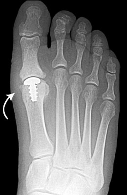 Arthrosurface After Surgery - University Foot and Ankle Institute