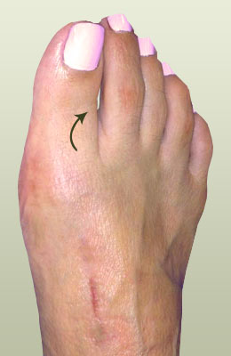 Hammertoe After Surgery - University Foot and Ankle Institute