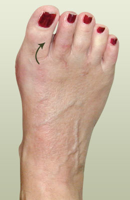 Bunion with Crossover After Surgery - University Foot and Ankle Institute