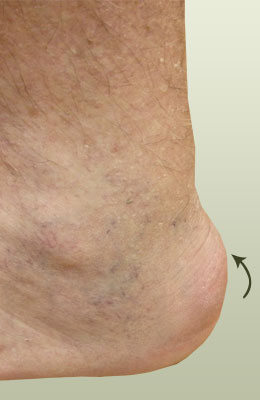 Achilles Spur Before Surgery - University Foot and Ankle Institute