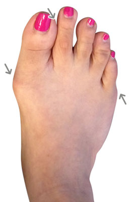 Lapidus Forever Bunionectomy, Before and After pictures