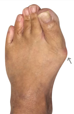 Osteotomy Bunionectomy Before Picture, University Foot and Ankle Institute Los Angeles