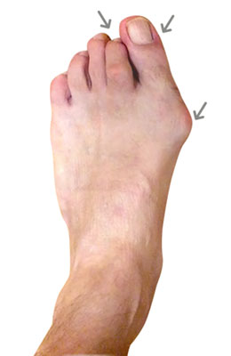 Lapidus, hammertoe and planter plate repair before image