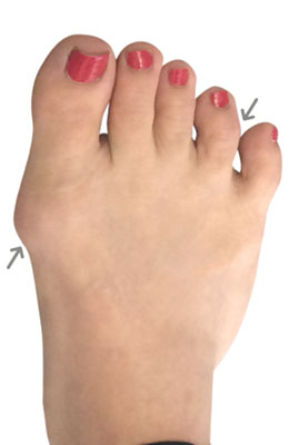 Lapidus Bunion Surgery Before Image