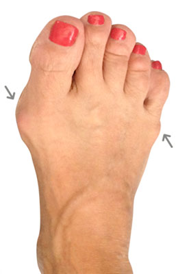 Osteotomy Bunion Surgery, University Foot and Ankle Institute, Before Picture