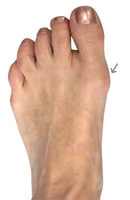 Bunionectomy Before Picture, UFAU