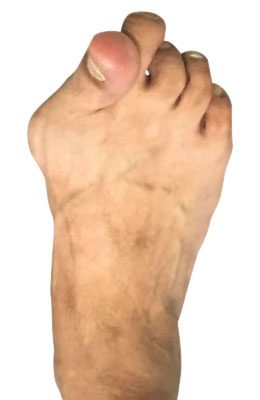 Bunion Surgery Before Picture, UFAI, Lapidus Bunionectomy