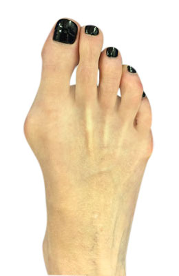 Osteotomy Bunionectomy and Tailors Bunionectomy Before Picture