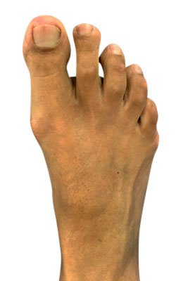Osteotomy Bunionectomy and Osteotomy Tailors Bunionectomy Before Picture