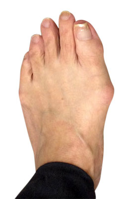 Osteotomy Bunion Surgery Before