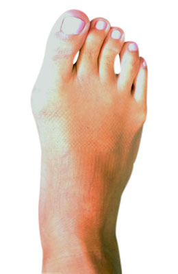 Lapidus Bunion Pciture Before Surgery, UFAI
