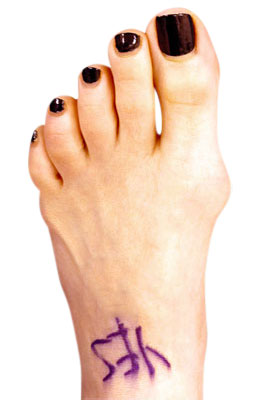 Bunion Before Surgery - University Foot and Ankle Institute