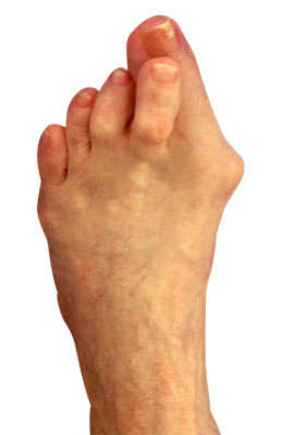 Before picture: Osteotomy Bunionectomy, Hammertoe Correction Plantar Plate Repair