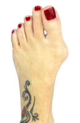 Before picture: Lapidus Bunionectomy