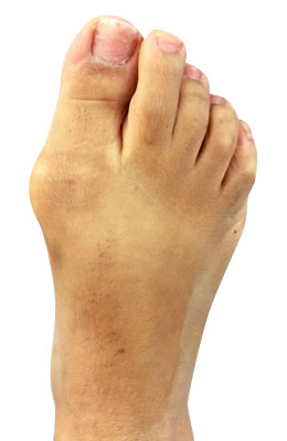 Lapidus Bunionectomy Surgery Before Picture, UFAI