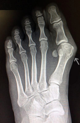 Lapidus Bunionectomy Surgery Before Picture