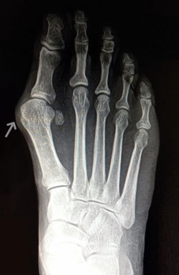 Lapidus Bunionectomy, Hammertoe Correction, Osteotomy Tailors Bunion Surgery Before, UFAI