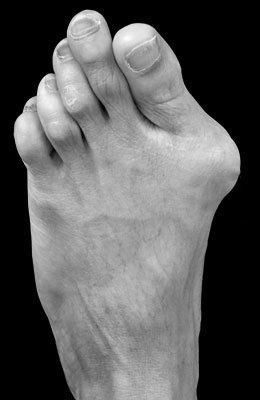 Lapidus Bunionectomy, Hammertoe 5th Intermediate Before Surgery, Univeristy Foot and Ankle Institute