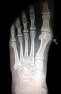 Head Osteotomy Before Surgery - University Foot and Ankle Institute