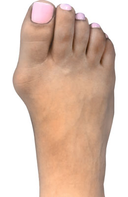 Forever bunionectomy, Before and after bunion pictures