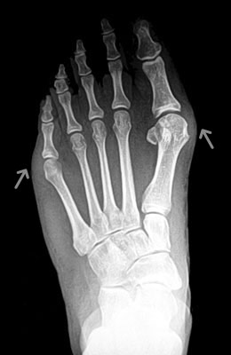 Lapidus Bunionectomy with Weil Procedure Before Surgery - Univeristy Foot and Ankle Institute