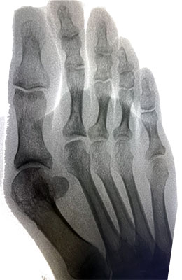 Lapiplasty bunion surgery before image