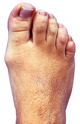 Minvasive minimally invasive bunion surgery before image