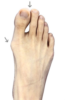 Osteotomy Bunionectomy, Los Angeles Bunion Surgeon, University Foot and Ankle Institute