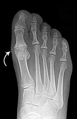 Hallux Limitus Bunion Surgery pre, University Foot and Anke Insittute